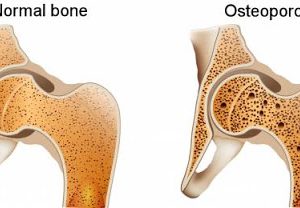 osteoporosis-pengeroposan-tulang